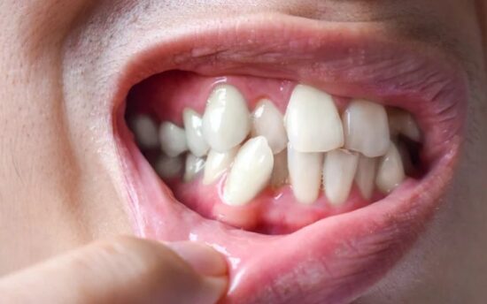 Crooked Teeth Alignment