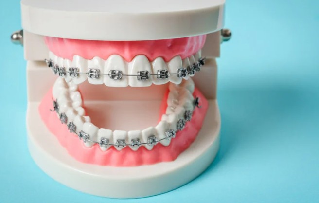 What to Expect During Your First Braces Appointment in Brookhaven