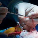 Transform Your Life - Gastric Bypass Surgery in Sydney