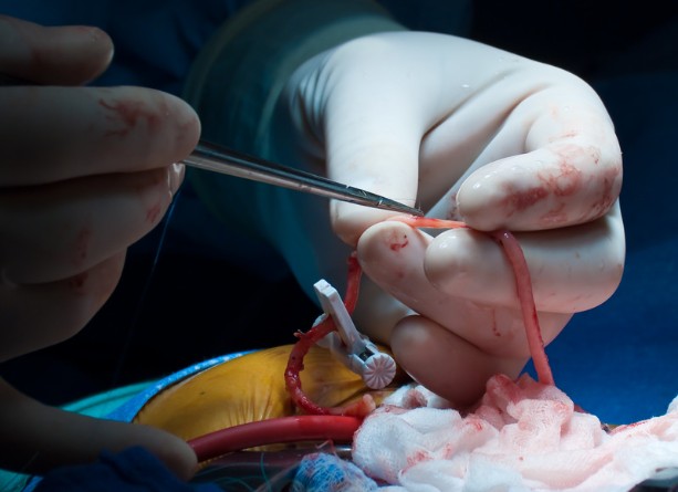 Transform Your Life: Gastric Bypass Surgery in Sydney