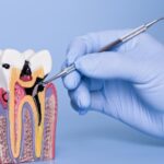 How Cavities Start - A Simple Guide to Tooth Decay