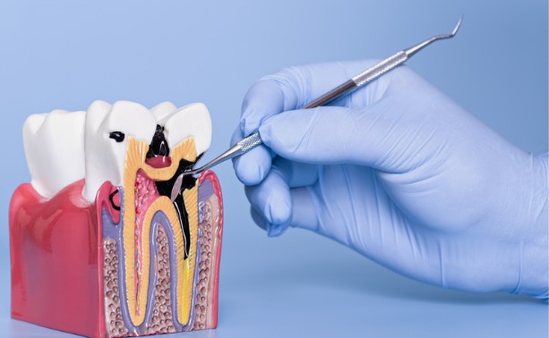 How Cavities Start: A Simple Guide to Tooth Decay